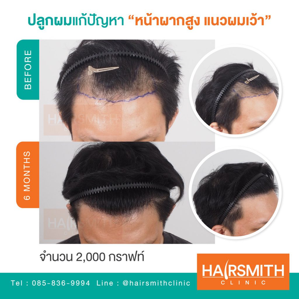 Hairsmith Clinic บริการปลูกผม - 2