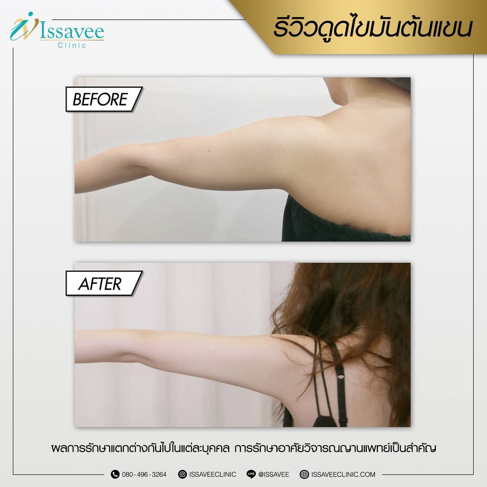 Issavee Clinic บริการดูดไขมัน - 2