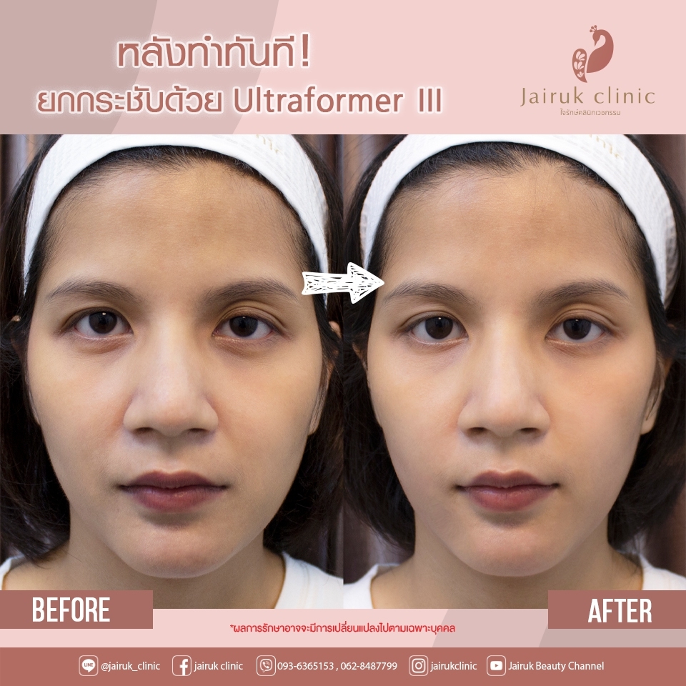 Jairuk Clinic บริการทำ Hifu - 2