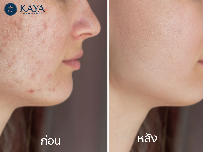 KAYA alternative poly Clinic คลินิกกดสิว เชียงใหม่ - 2