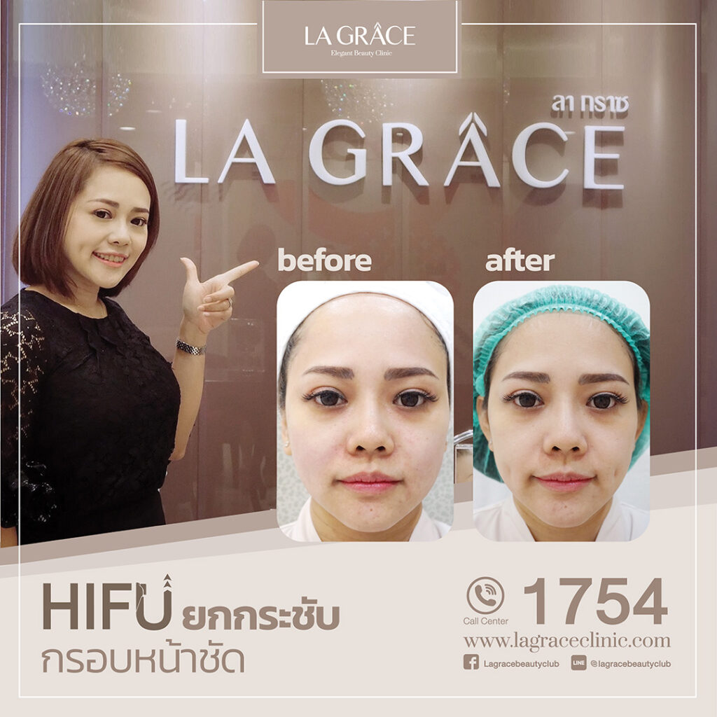 La Grace Clinic คลินิกทำ Hifu - 2