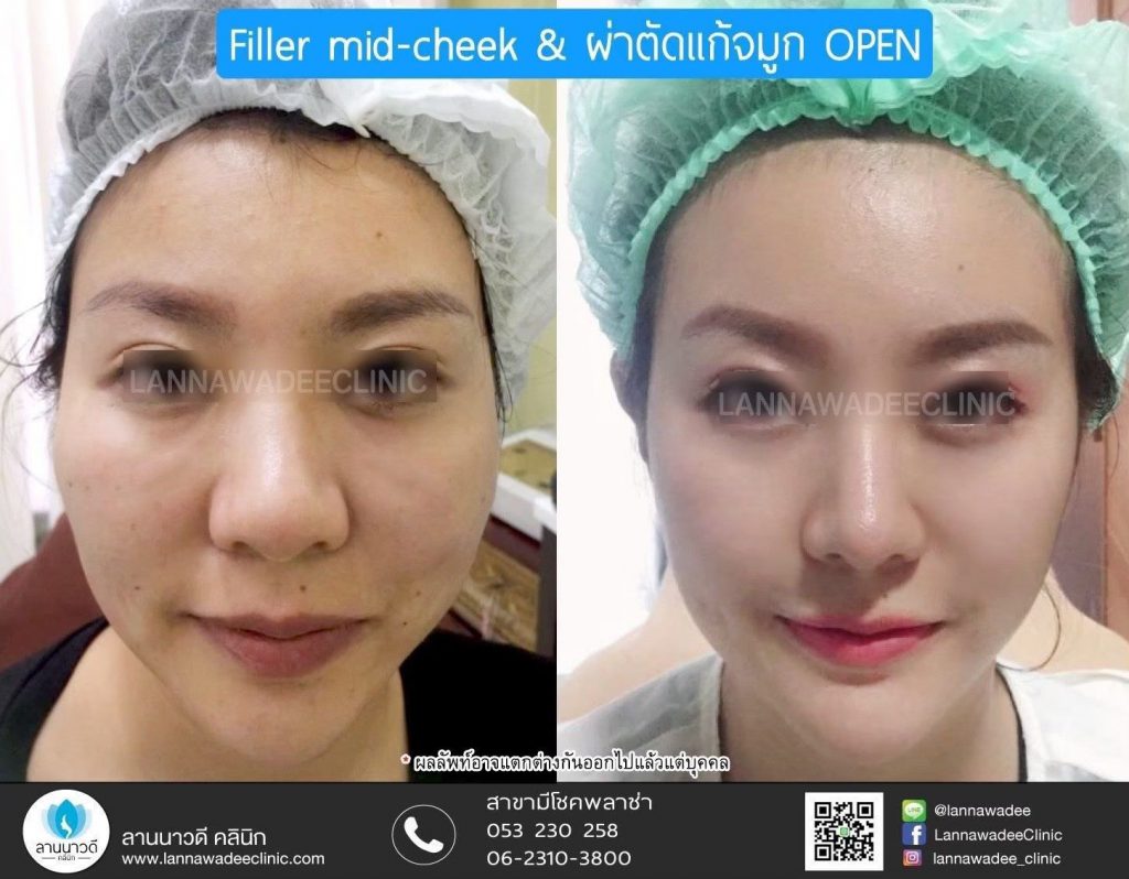 Lannawadee Clinic คลินิกฉีดฟิลเลอร์ เชียงใหม่ - 2