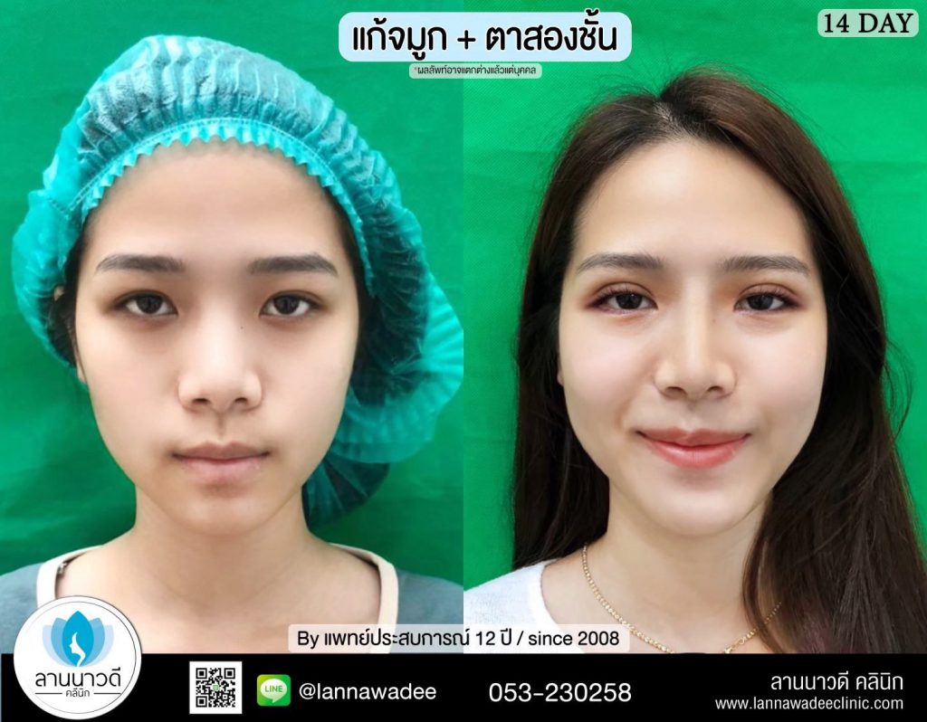 Lannawadee Clinic บริการทำจมูก เชียงใหม่ - 2