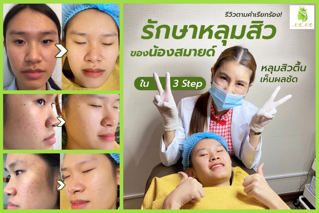 Lelalyn Clinic รักษาหลุมสิว เชียงใหม่ - 2