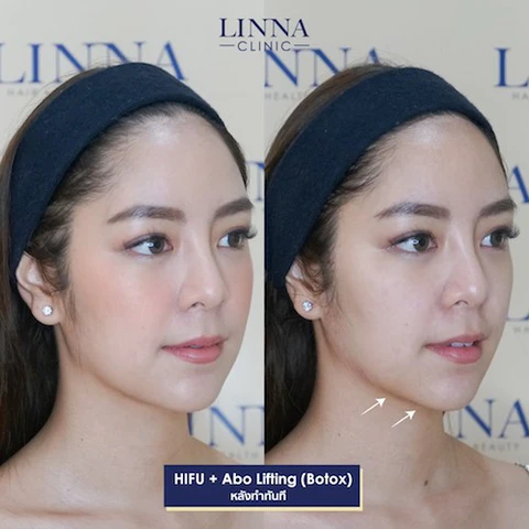Linna Clinic บริการทำ Hifu - 2