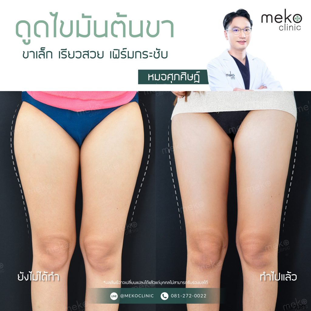 Meko Clinic บริการดูดไขมัน - 2