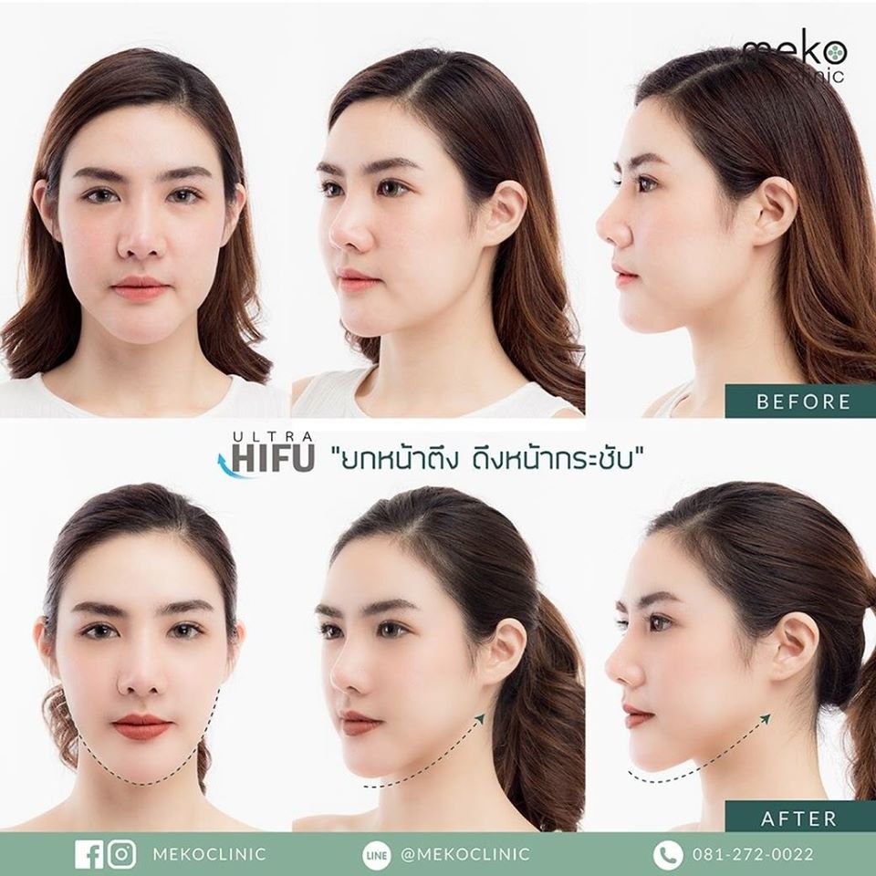 Meko Clinic บริการทำ Hifu - 2