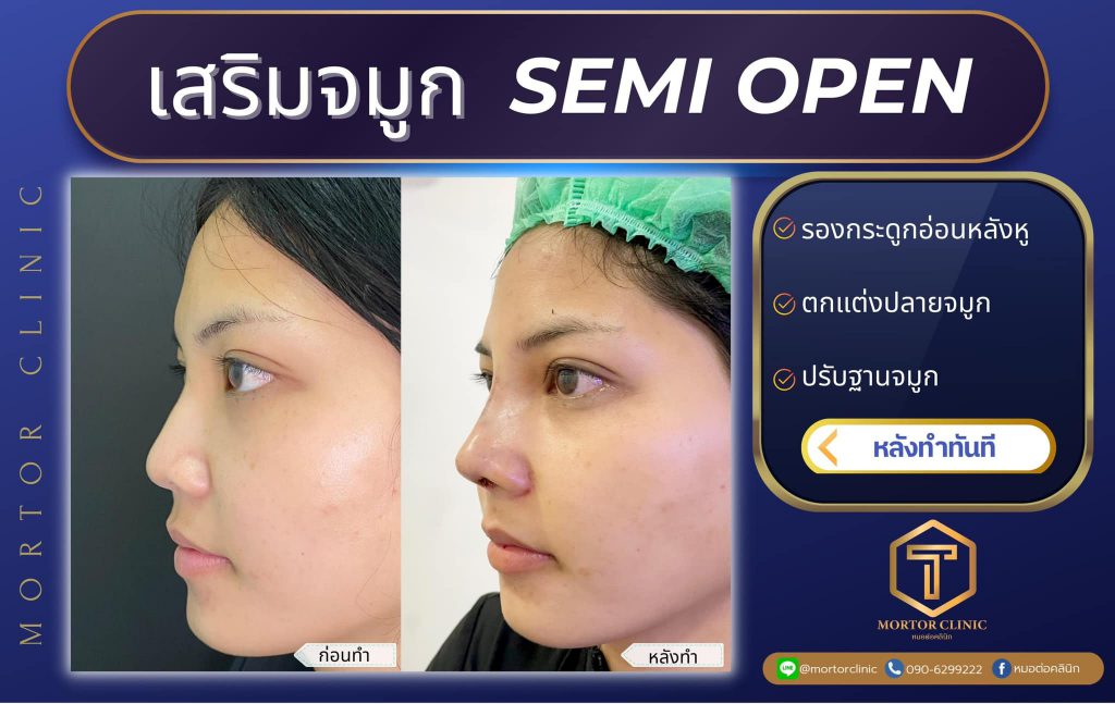 Mortor Clinic คลินิกทำจมูก เชียงใหม่ - 2