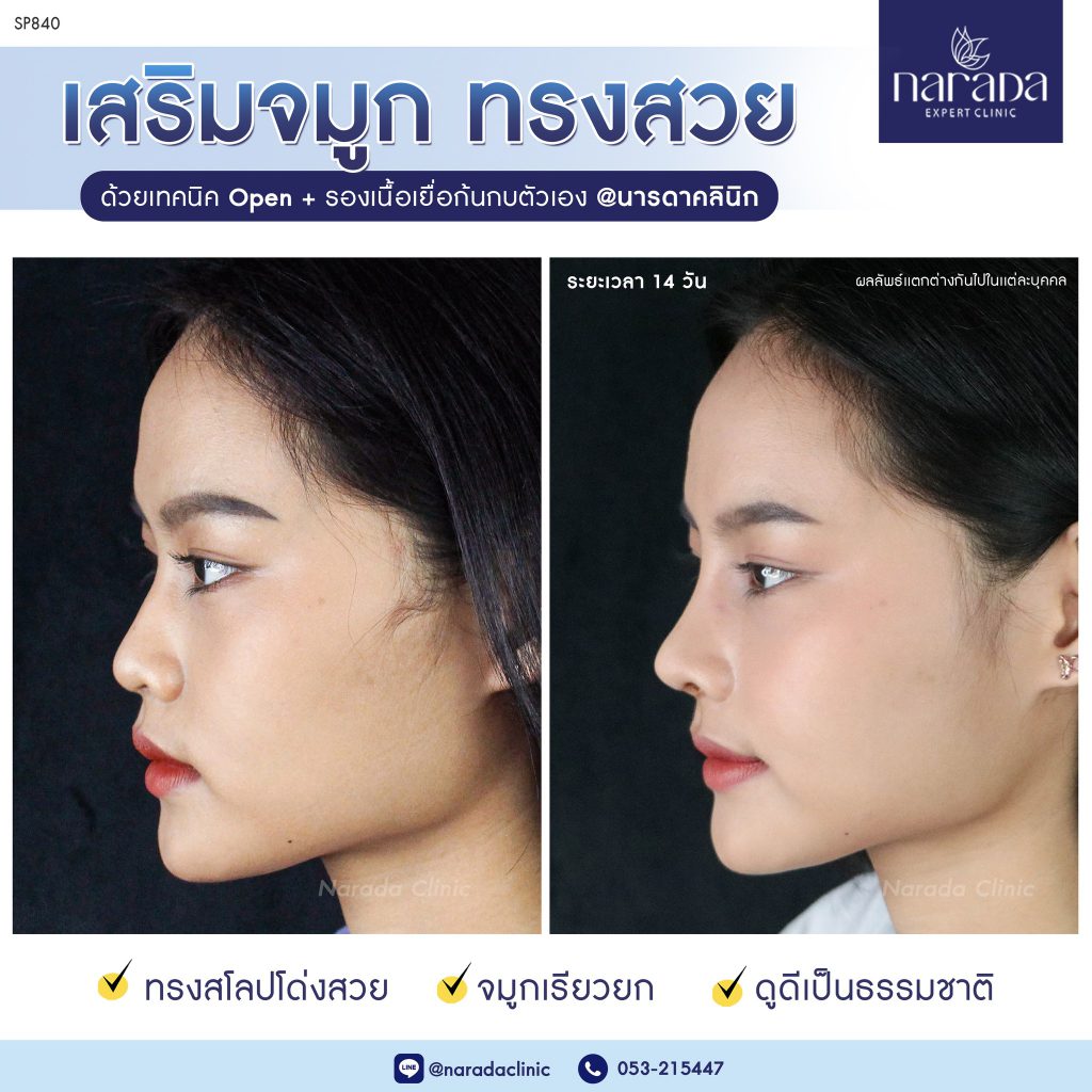 NARADA Clinic คลินิกทำจมูก เชียงใหม่ - 2