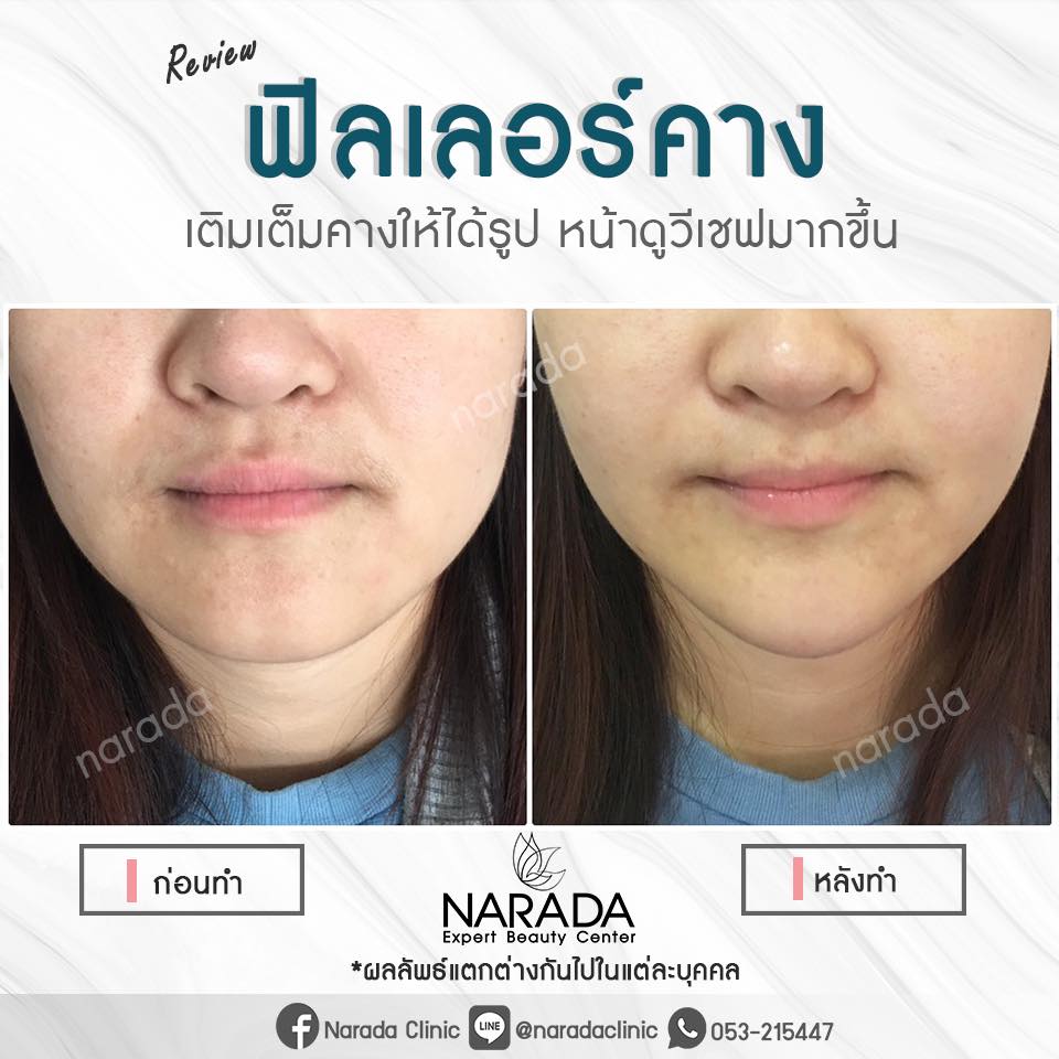 Narada Clinic คลินิกฉีดฟิลเลอร์ เชียงใหม่ - 2