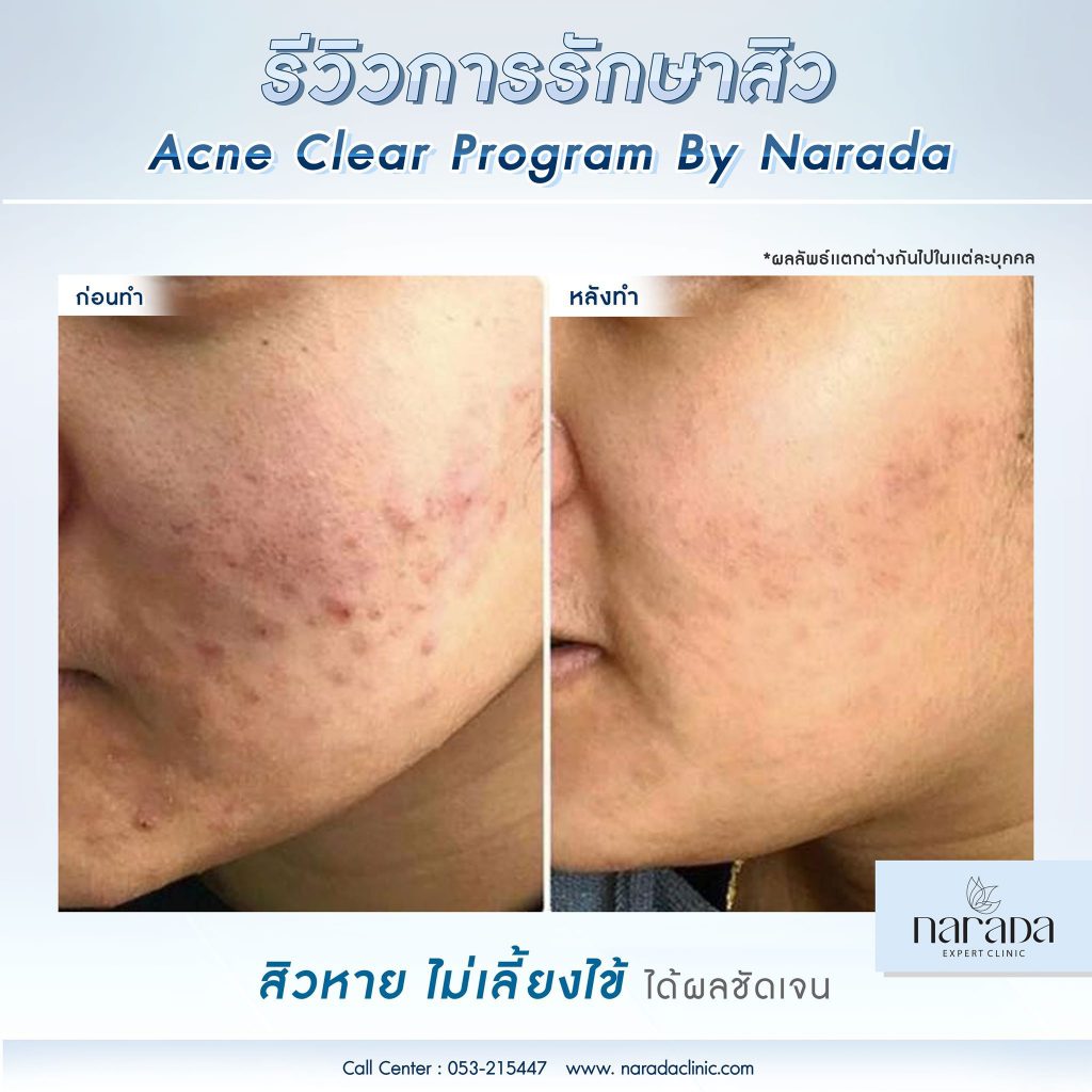 Narada Clinic บริการตัดพังผืดหลุมสิว เชียงใหม่ - 2