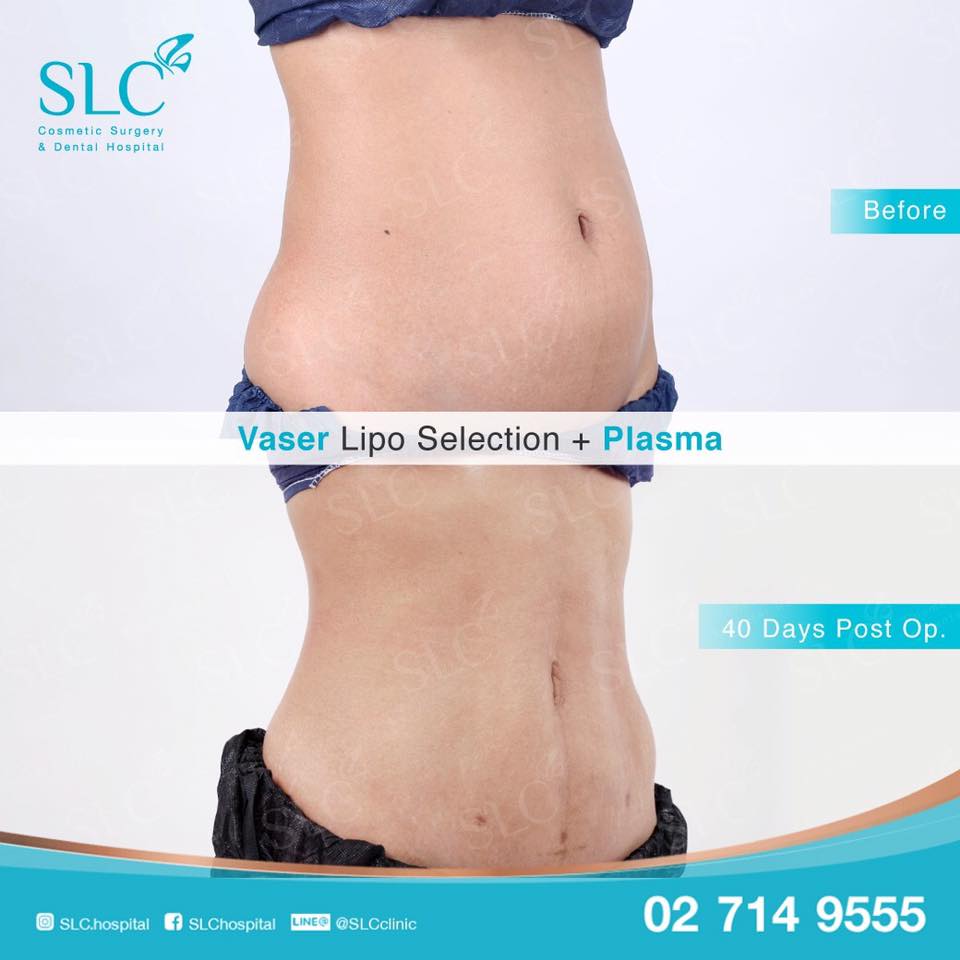 SLC Siam Laser Clinic คลินิกดูดไขมัน - 2