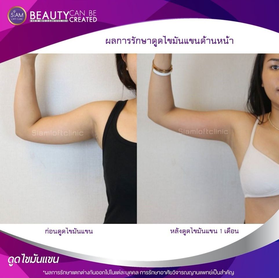 Siam Loft Clinic บริการดูดไขมัน - 2