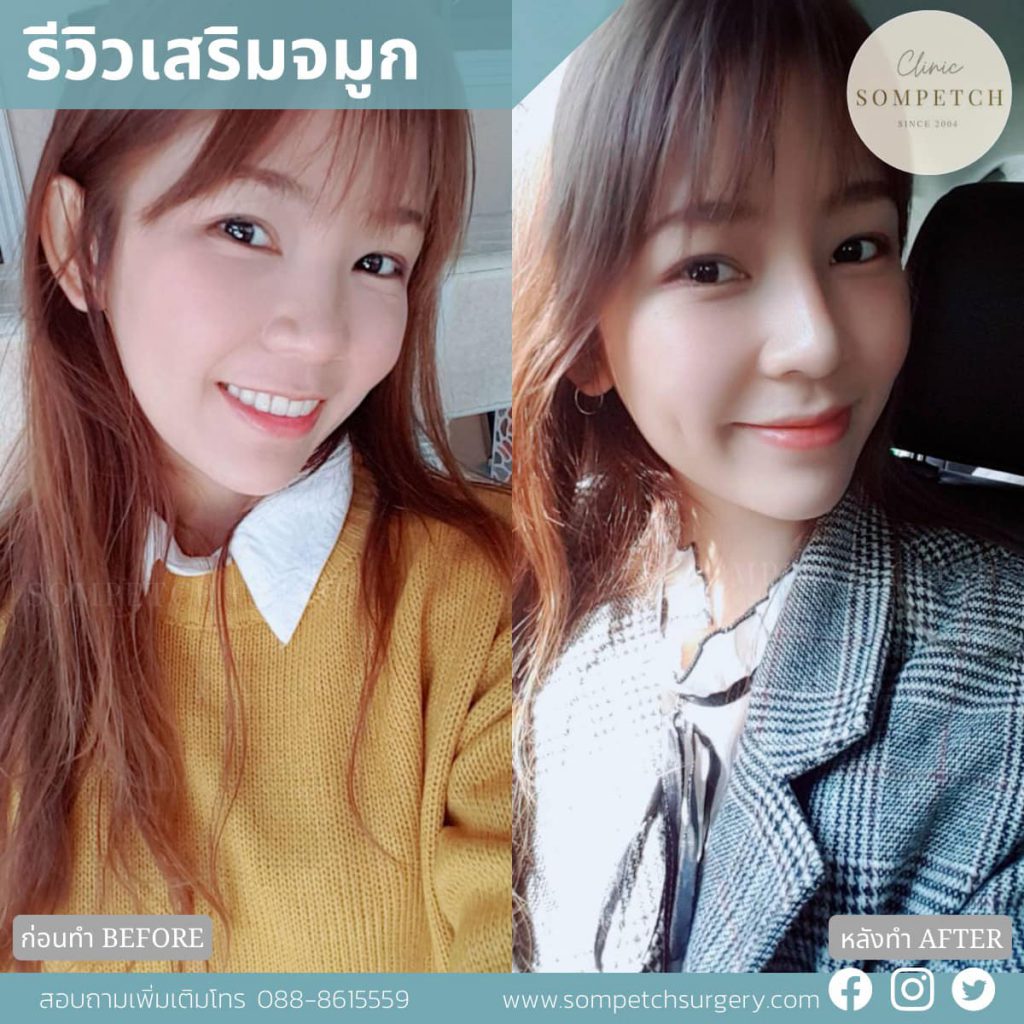 SomPetch clinic คลินิกศัลยกรรมจมูก เชียงใหม่ - 2