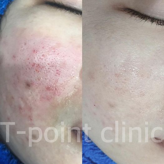 T-Point Clinic บริการตัดพังผืดหลุมสิว เชียงใหม่ - 2