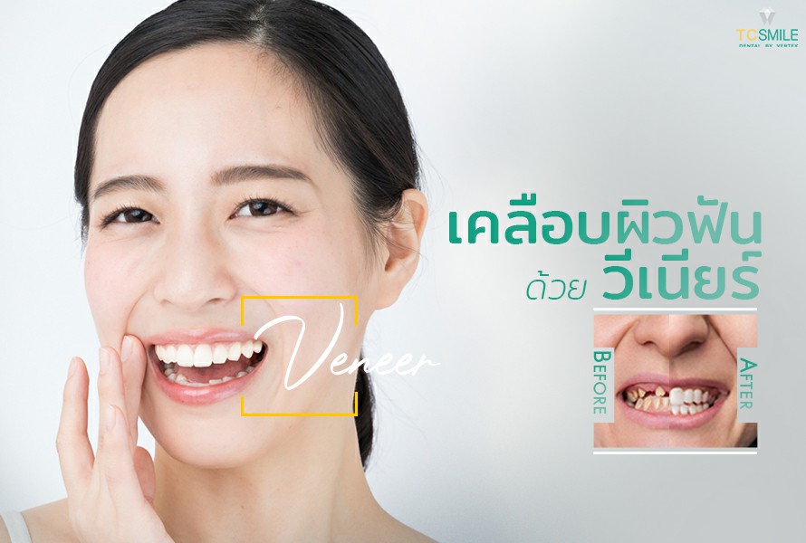 TC Smile Dental บริการทำวีเนียร์ - 1