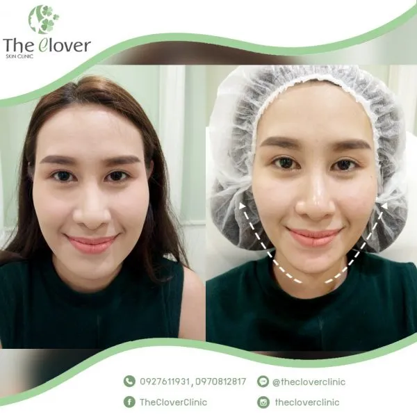 The Clover Clinic คลินิกทำ Hifu - 2