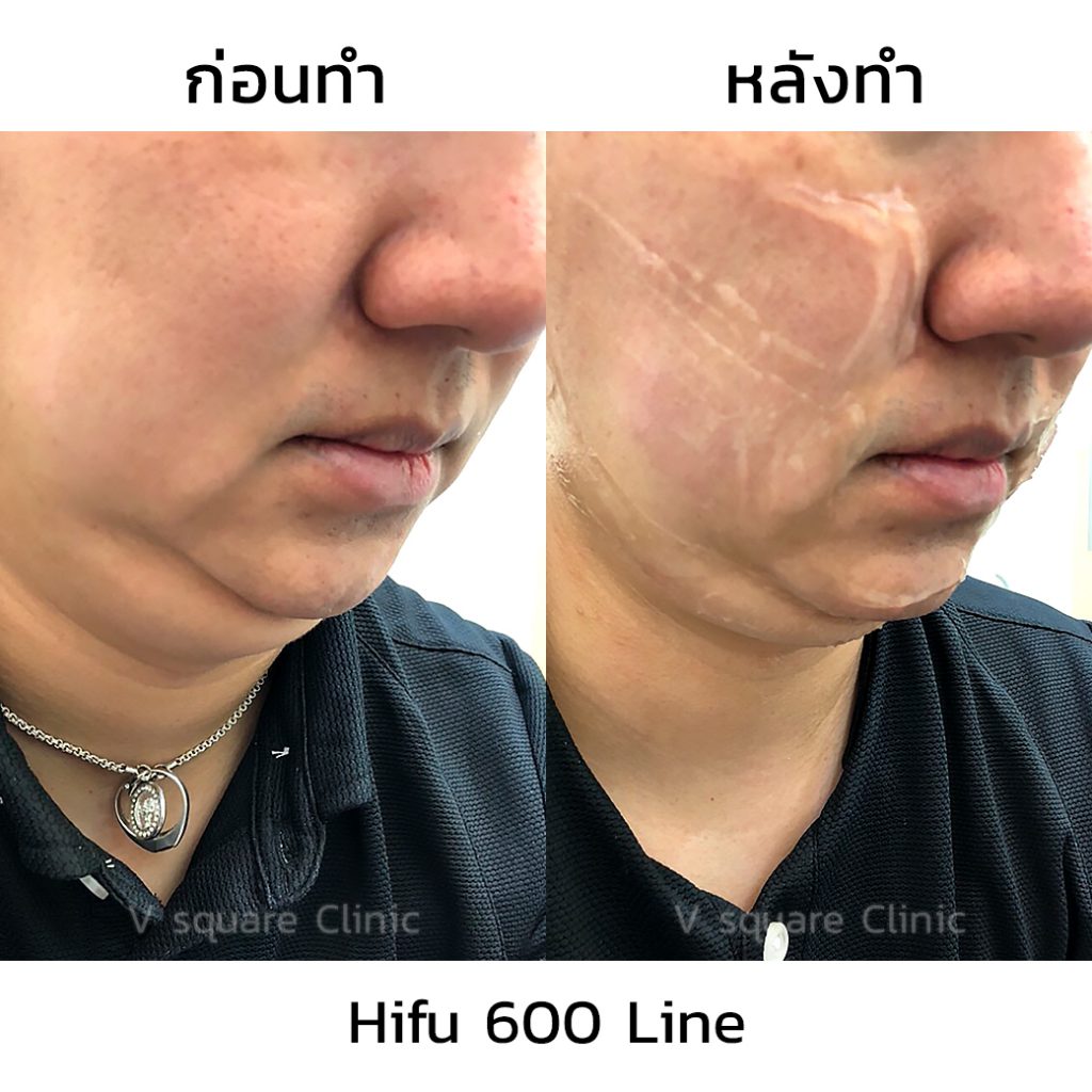 V Square Clinic บริการทำ Hifu - 2