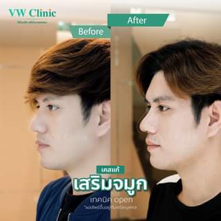 VW-Clinic คลินิกทำจมูก เชียงใหม่ - 2