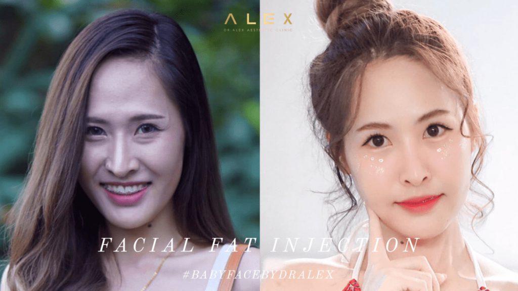 Alex Clinic บริการฉีดไขมันหน้า - 2