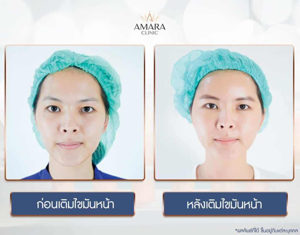 Amara Clinic บริการฉีดไขมันหน้า - 2