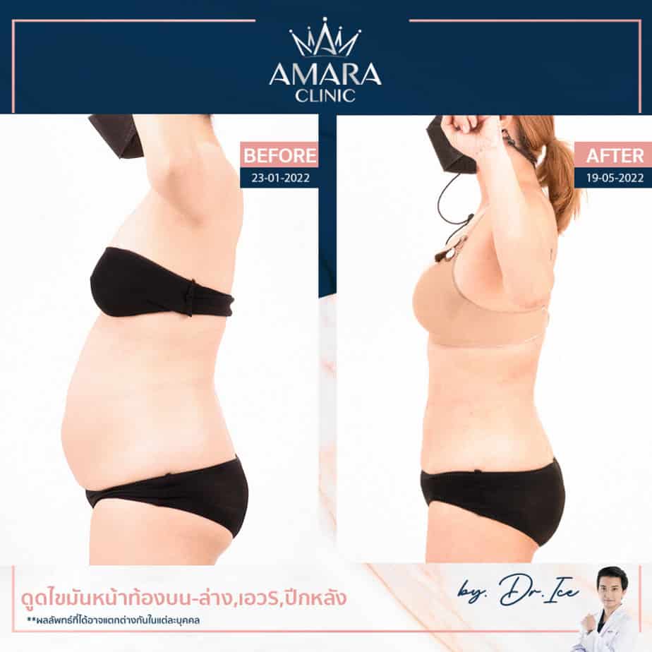 Amara Clinic บริการดูดไขมัน - 2