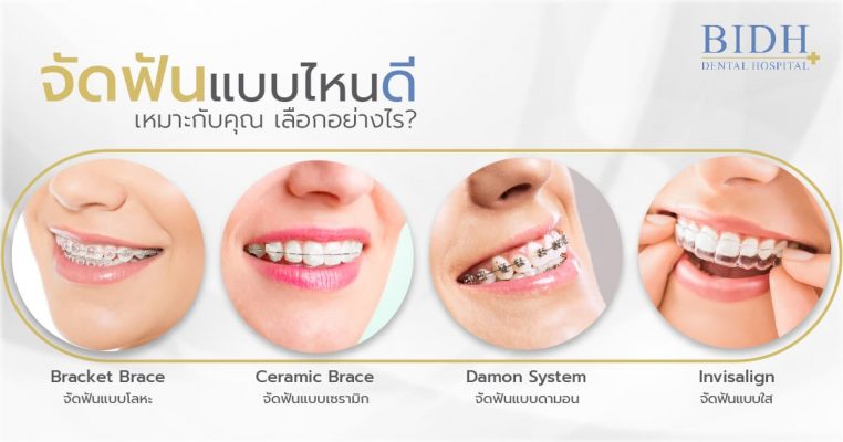 BIDH Dental Hospital จัดฟันแบบดามอน - 2