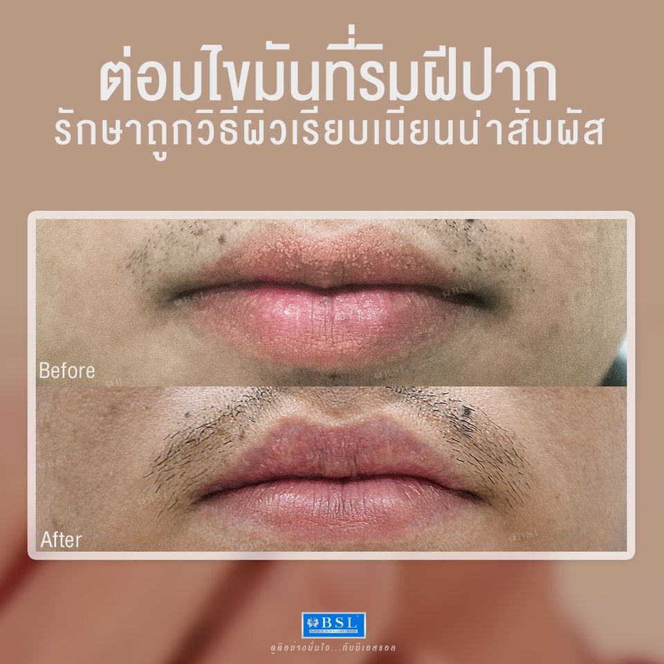 BSL Clinic คลินิกเลเซอร์ต่อมไขมัน - 2