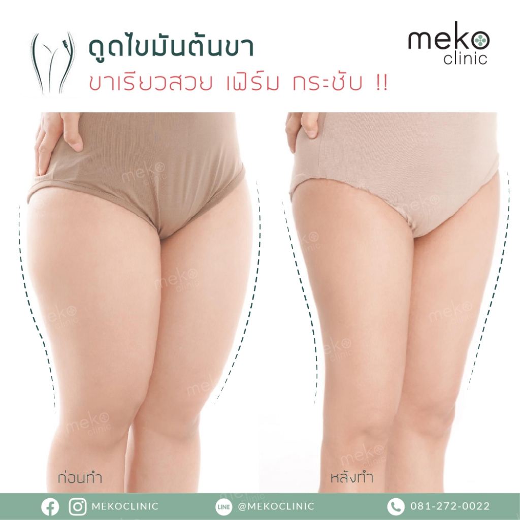 Meko Clinic คลินิกดูดไขมัน - 2