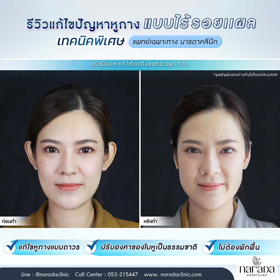 Narada Clinic คลินิกแก้ไขหูกาง - 2