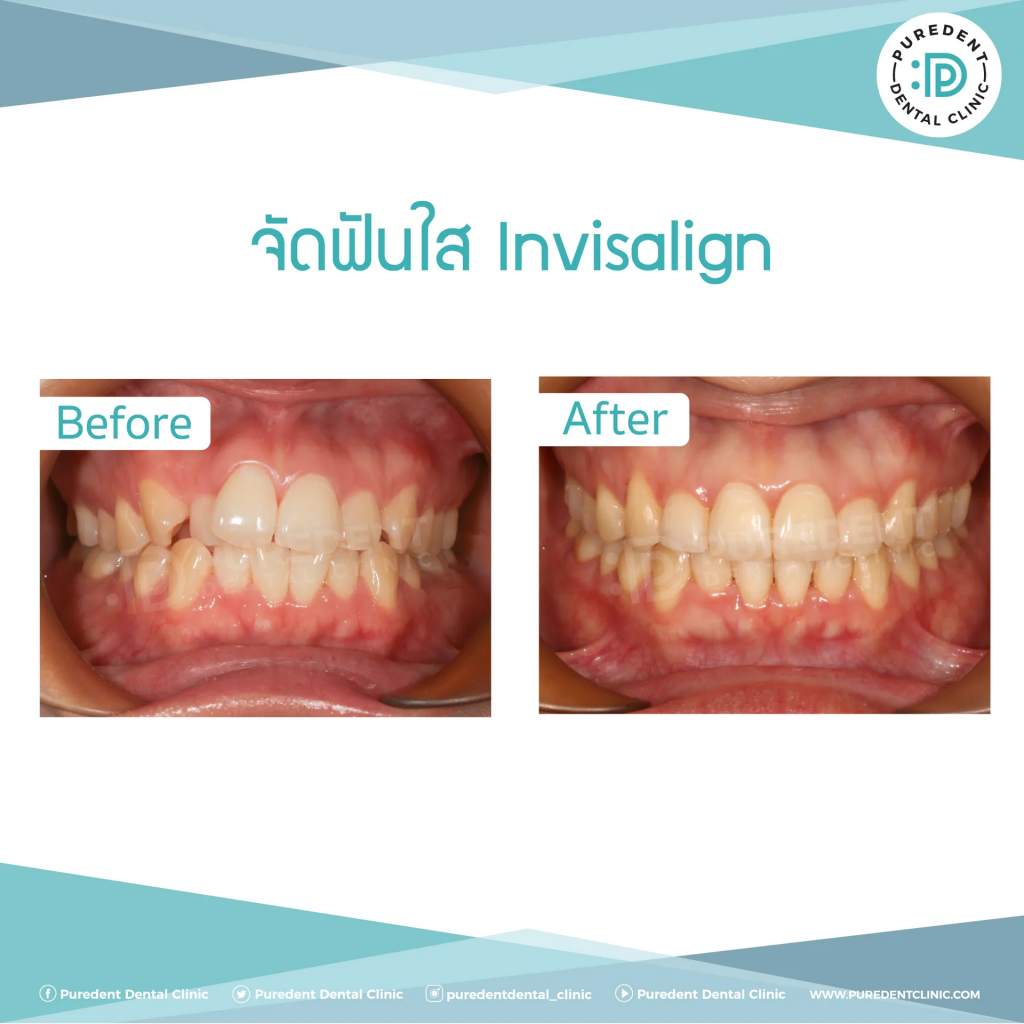 Puredent Dental Clinic บริการจัดฟันแบบดามอน - 2