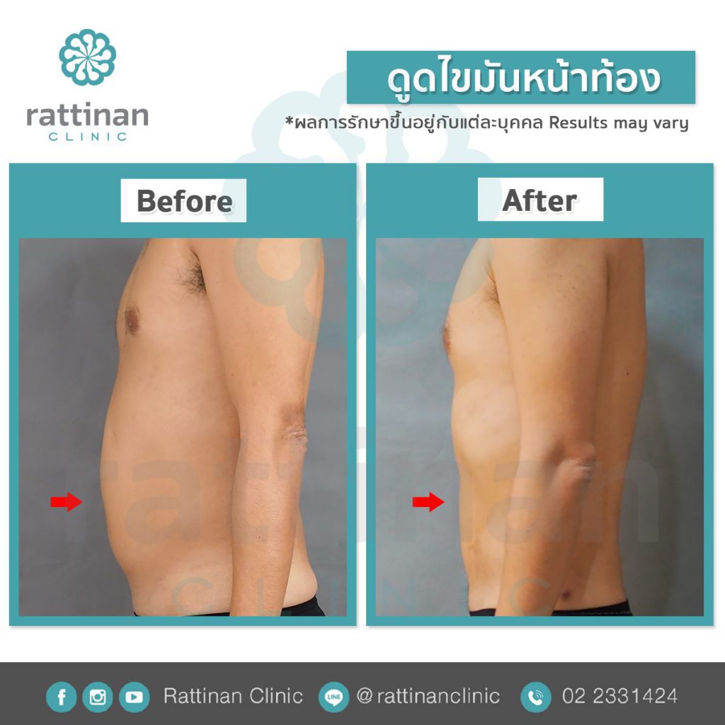 Rattinan Medical Center คลินิกดูดไขมัน - 2