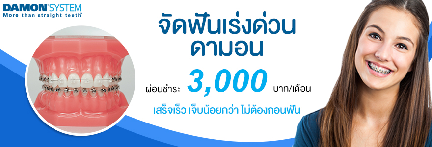 Smile Signature คลินิกจัดฟันแบบดามอน - 1