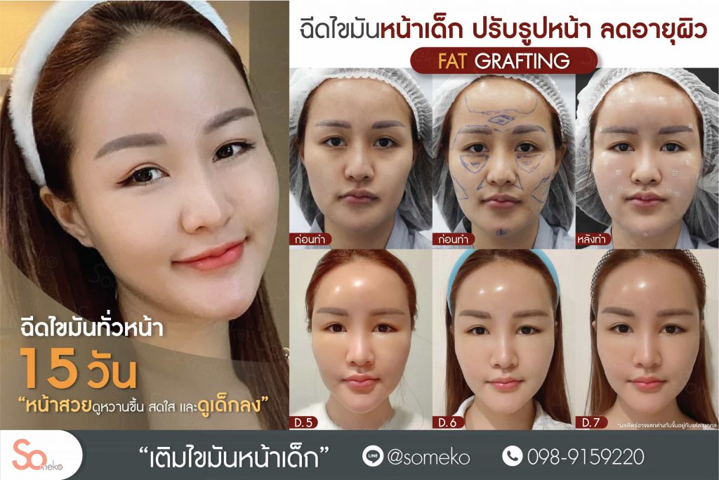 Someko Clinic คลินิกฉีดไขมันหน้า - 1