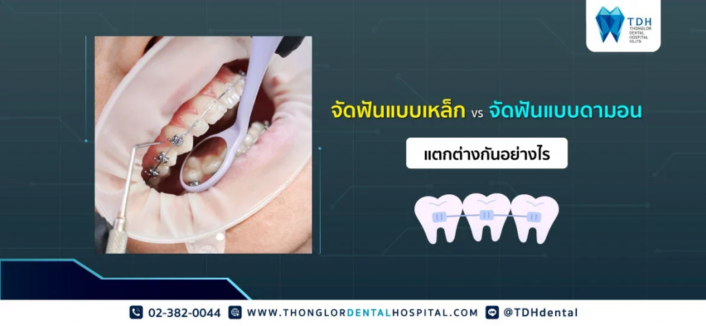 TDH Tonglor Dental Hospital บริการจัดฟันแบบดามอน - 1