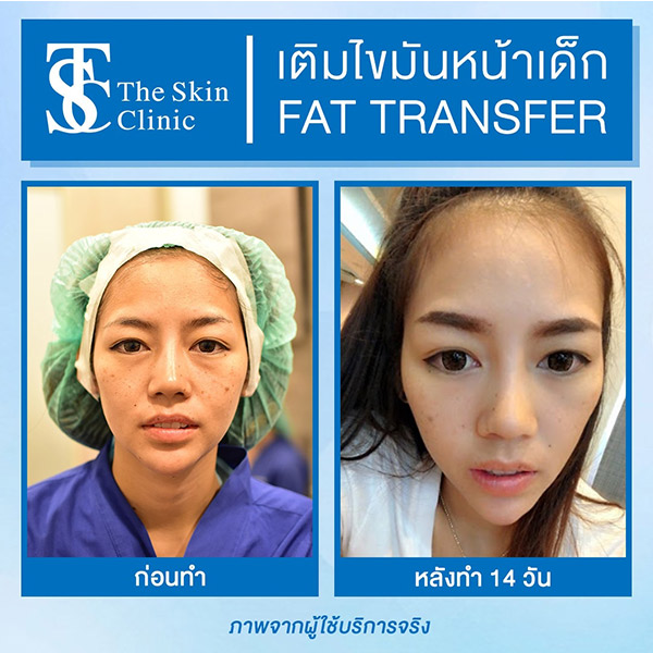 TSC Clinic บริการฉีดไขมันหน้า - 2