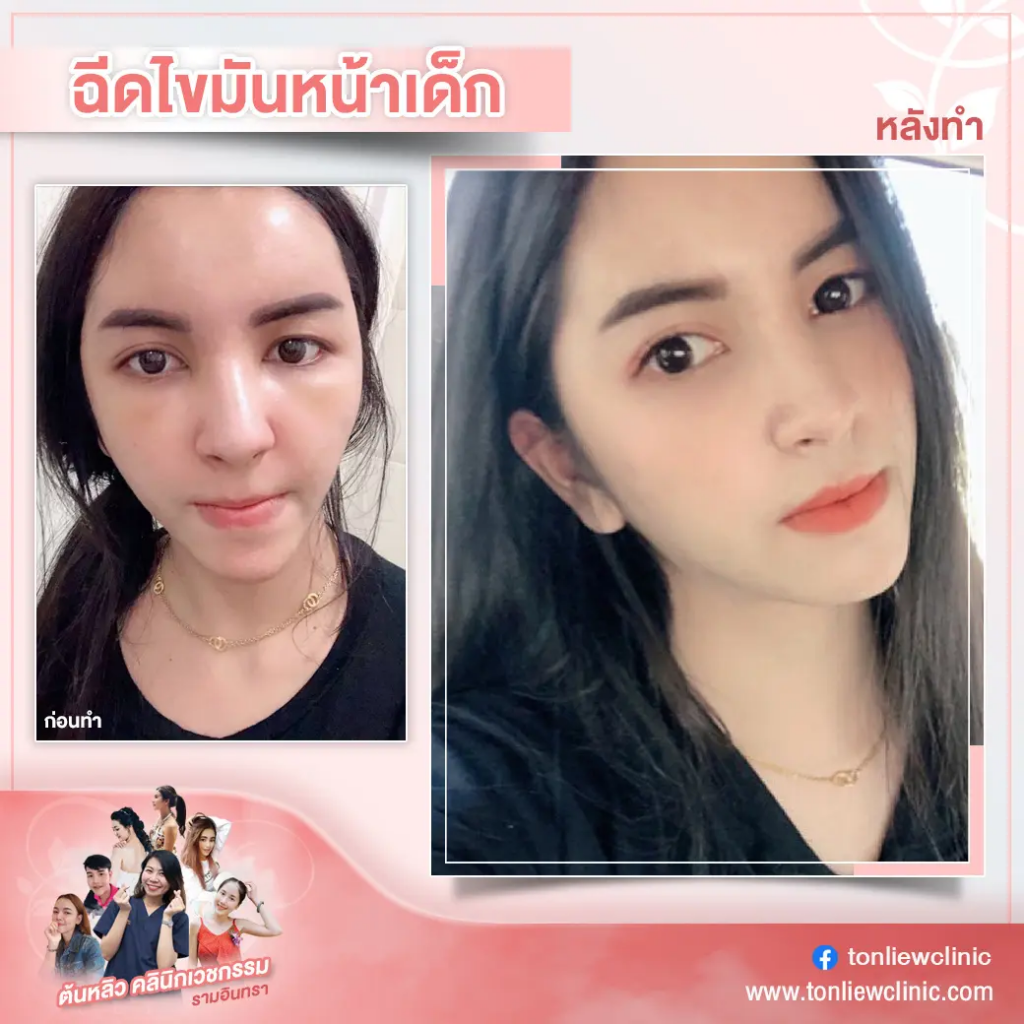 Tonliew Clinic คลินิกฉีดไขมันหน้า - 2