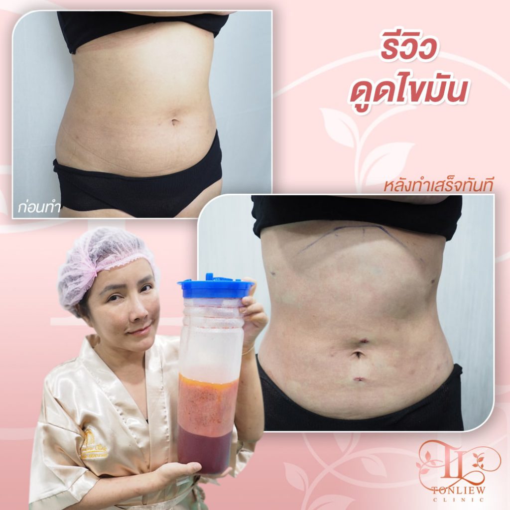 Tonliew Clinic บริการดูดไขมัน - 2