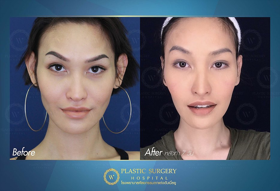 W Plastic Surgery Hospital โรงพยาบาลแก้ไขหูกาง - 2