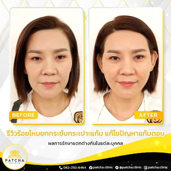 รีวิวร้อยไหม Patcha Clinic พัชชาคลินิก