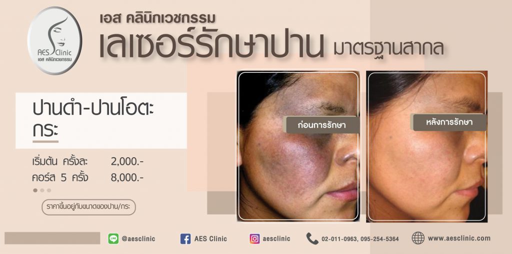 AES Clinic คลินิกเลเซอร์ปาน ปรับสมดุลของผิวให้กลับมามั่นใจอีกครั้ง - 2