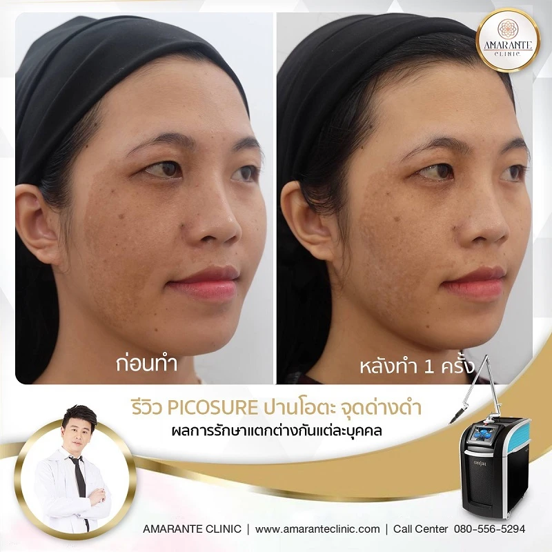 Amarante Clinic บริการเลเซอร์ปาน ปรับสภาพผิวจากรอยปานด้วย Picosure Laser - 2