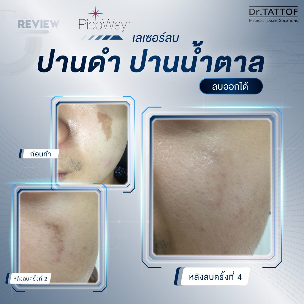 Dr.TATTOF เลเซอร์ปาน ลบรอยแผลเป็น รอยสัก รอยด่างคล้ำ อย่างมีประสิทธิภาพ - 2