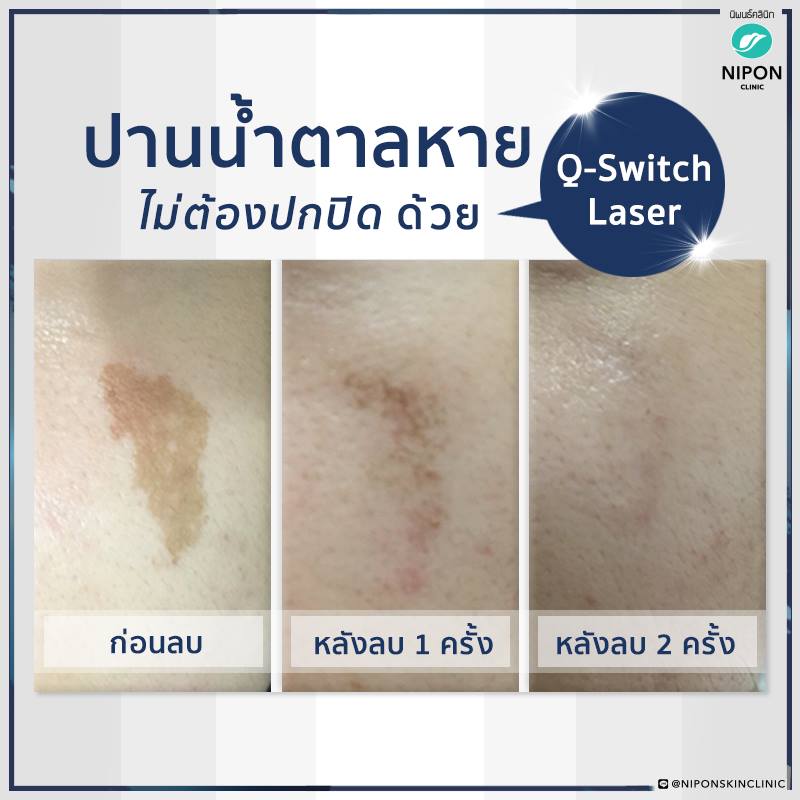 Nipon Clinic เลเซอร์ลบรอยปาน ปรับผิวหมองคล้ำ จุดด่างดำ รอยสิวหายหมดในที่เดียว - 2