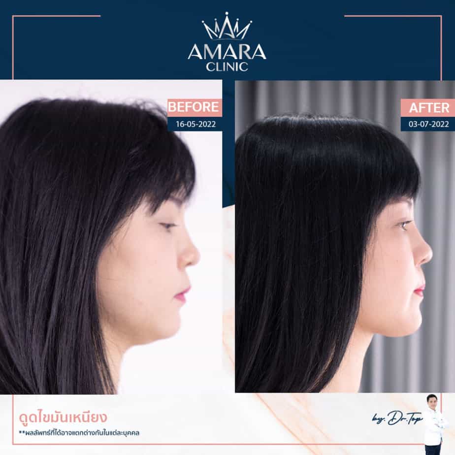 Amara Clinic คลินิกดูดไขมันเหนียง หน้าเรียวสวย กรอบหน้าคมชัด - 2