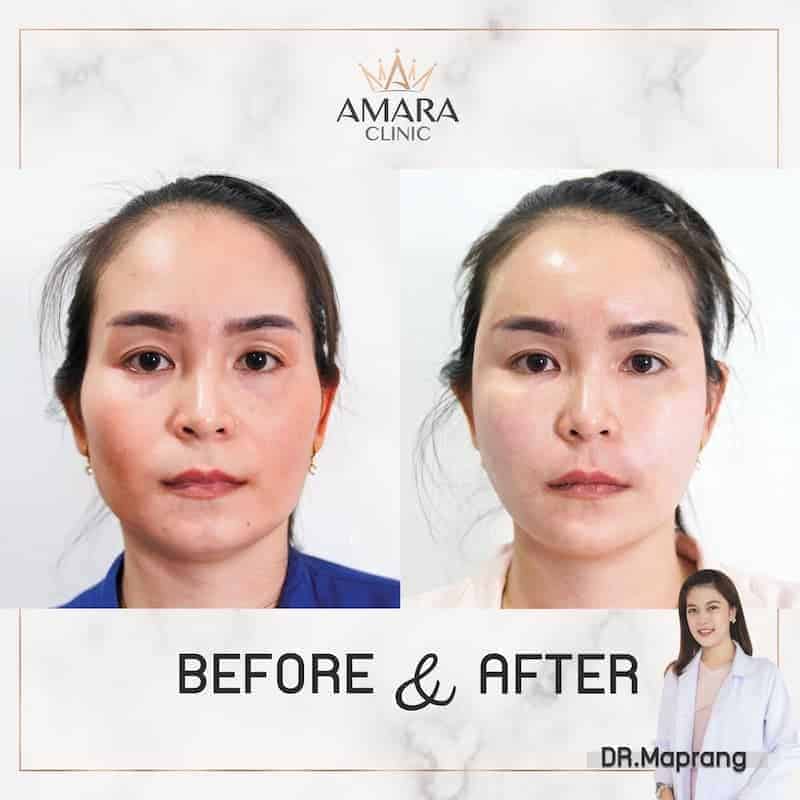 Amara Clinic บริการฉีดไขมันหน้า เติมเต็มส่วนที่ขาดบนใบหน้าด้วยไขมันตัวเอง - 2