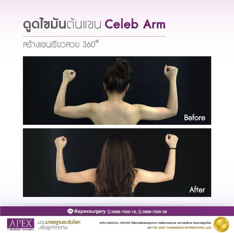 Apex Medical Center คลินิกดูดไขมันต้นแขน สร้างความกระชับ ฟื้นฟูเซลล์ผิวในขั้นตอนเดียว - 2