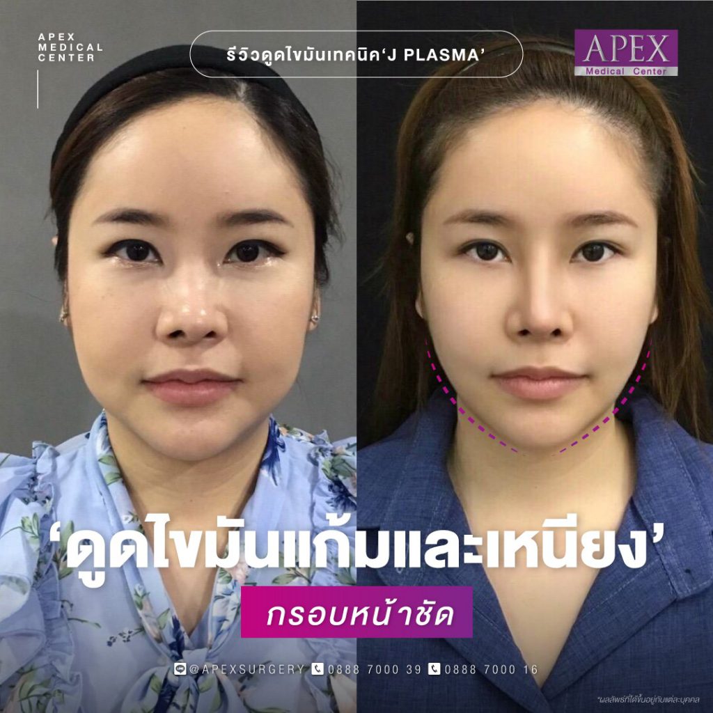 Apex Medical Center คลินิกดูดไขมันเหนียง พร้อมสร้างความกระชับให้ผิวเต่งตึงตลอดวัน - 2