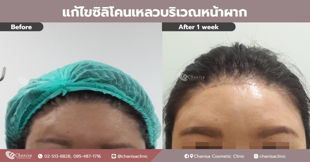 Chanisa Cosmetic Clinic เสริมหน้าผาก ปรับความโค้งนูนบนหน้าผาก - 2