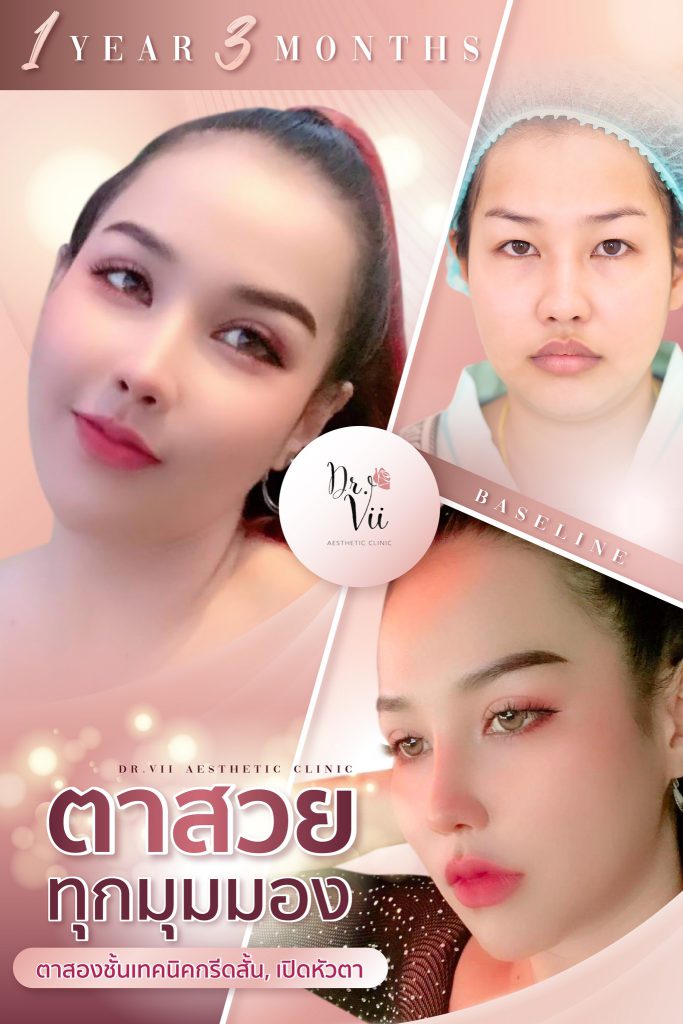 Dr.Vii Aesthetic Clinic คลินิกยกคิ้ว เสริมความกระชับผิวเปลือกตา ลบริ้วรอย ดูเป็นธรรมชาติ - 2